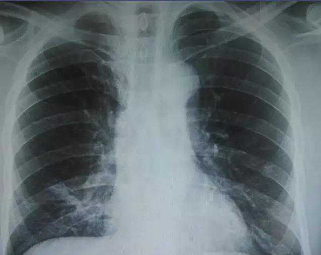 CT、核磁、B超的区别，讲的太到位了！