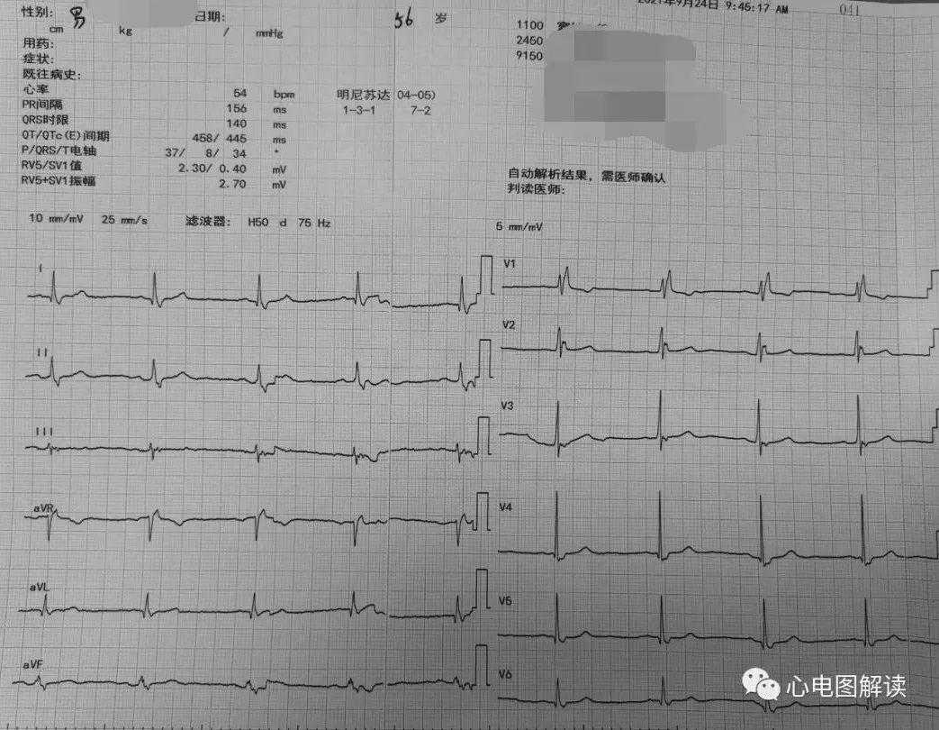 今天要分享的心电图